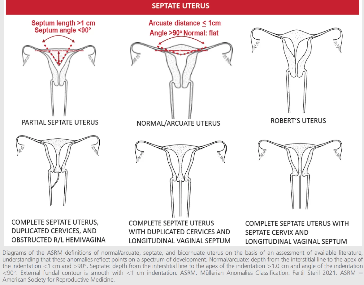 Figure1-Evidence-Diagnosis-Uterine-Septum.webp